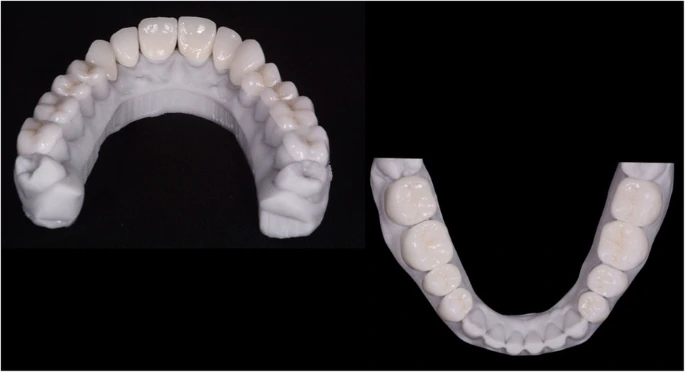 Impact of Parafunctional Habits on Prosthetic Success: Considering Occlusion and Functional Dynamics 8 Upper and lower definitive restorations on laboratory models.