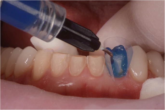 Impact of Parafunctional Habits on Prosthetic Success: Considering Occlusion and Functional Dynamics 9 Clinical close-up showing material application during adhesive delivery.