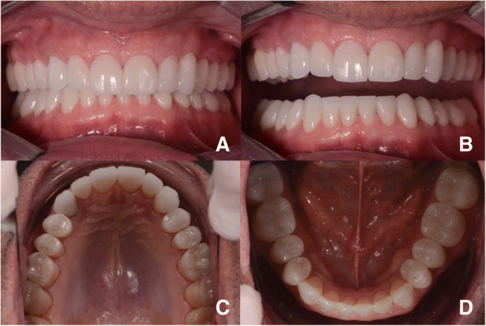 Impact of Parafunctional Habits on Prosthetic Success: Considering Occlusion and Functional Dynamics 10 Four post-treatment views of the restored front teeth and upper and lower arches.