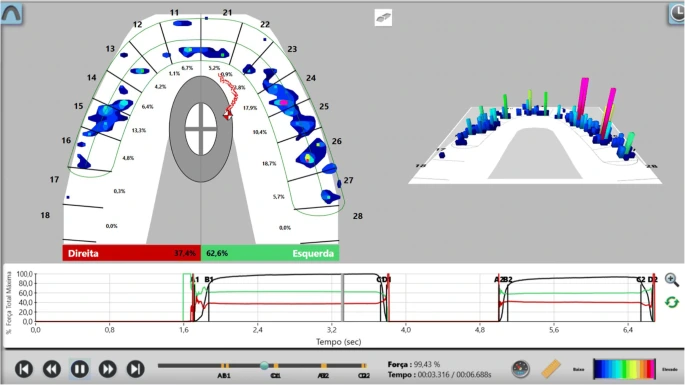 Impact of Parafunctional Habits on Prosthetic Success: Considering Occlusion and Functional Dynamics 11 T-Scan display with relative force distribution and contact-time graphs.