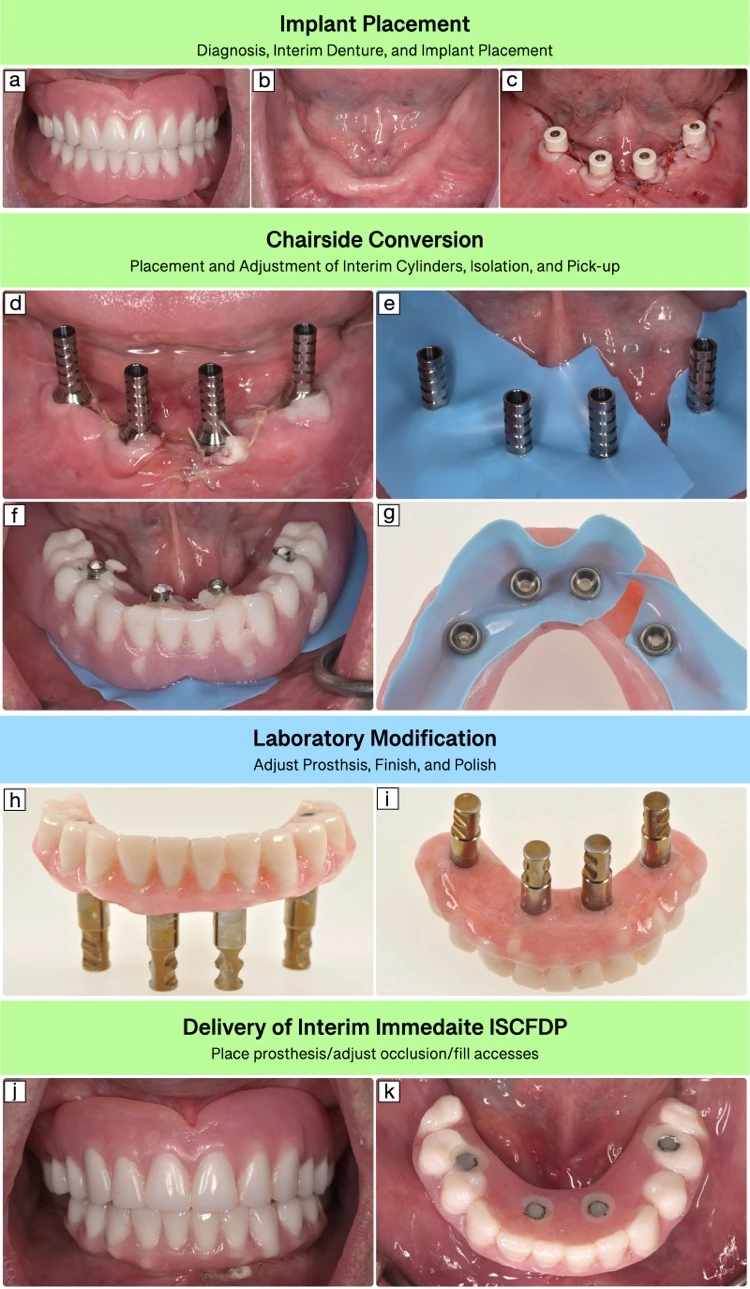 Clinical sequence of conventional denture conversion with implant cylinders, rubber-dam isolation, acrylic pickup, finishing, and delivery.