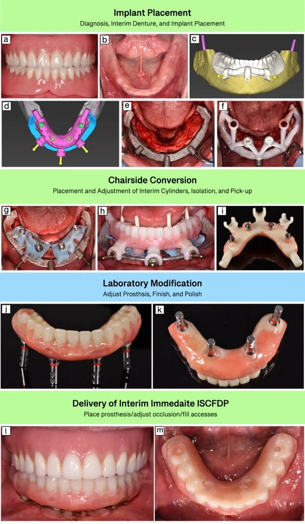 Digital guide designs and clinical stages of guided full-arch provisional conversion and delivery.