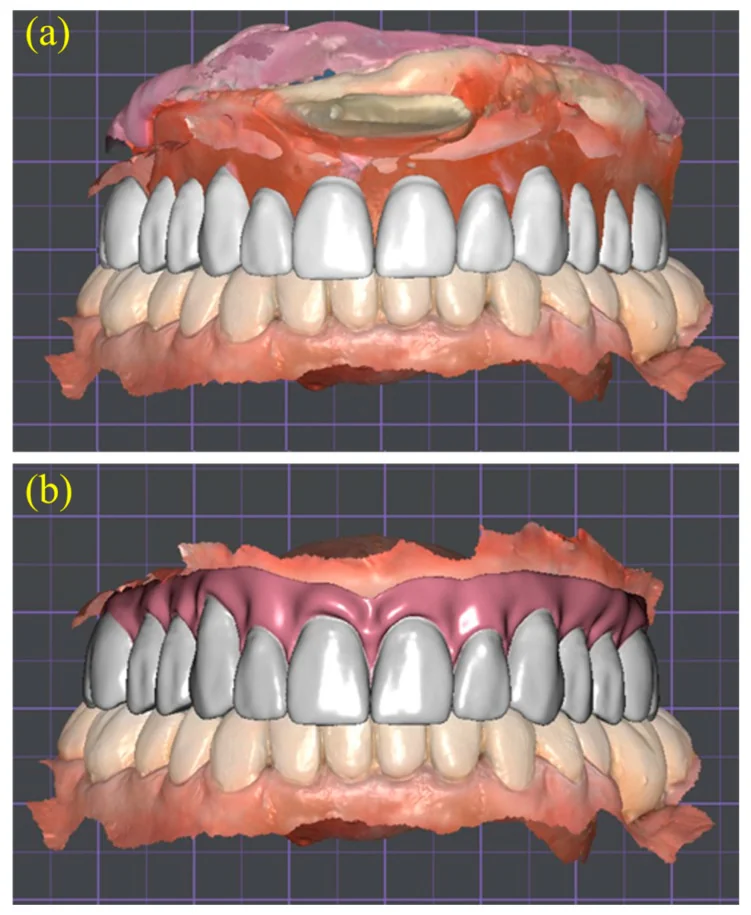 Two DentalCAD screenshots showing virtual maxillary tooth placement and the completed tooth-and-gingiva setup.