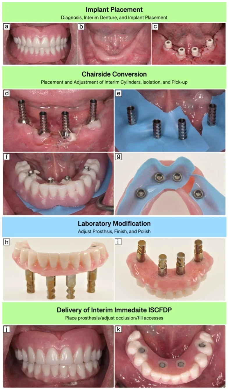 Clinical sequence of conventional denture conversion with implant cylinders, rubber-dam isolation, acrylic pickup, finishing, and delivery.