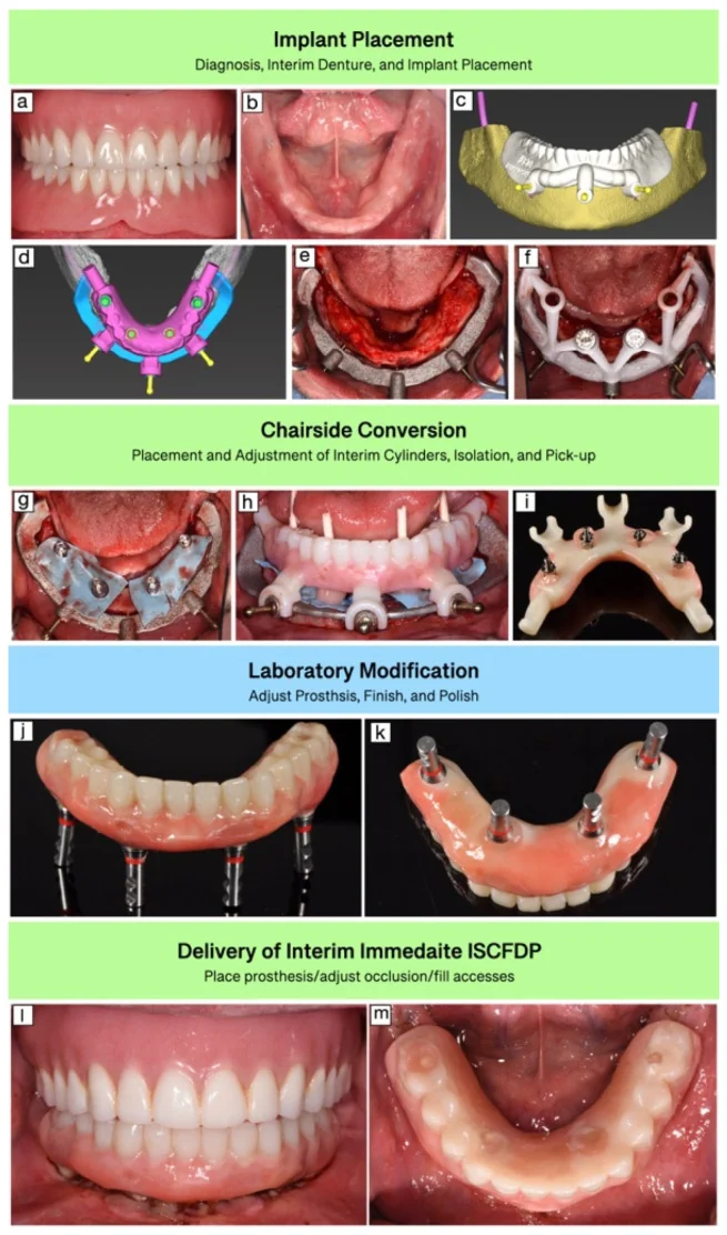 Digital guide designs and clinical stages of guided full-arch provisional conversion and delivery.
