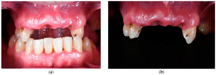 Initial intraoral views of a partially dentate maxillary arch before immediate-load PMMA rehabilitation.