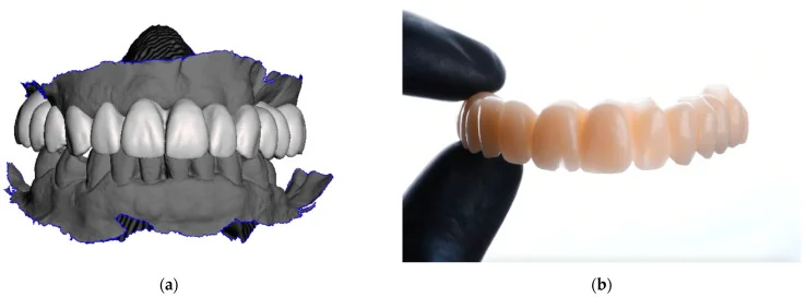 Digital full-arch interim prosthesis design beside a tooth-colored milled PMMA prosthesis.