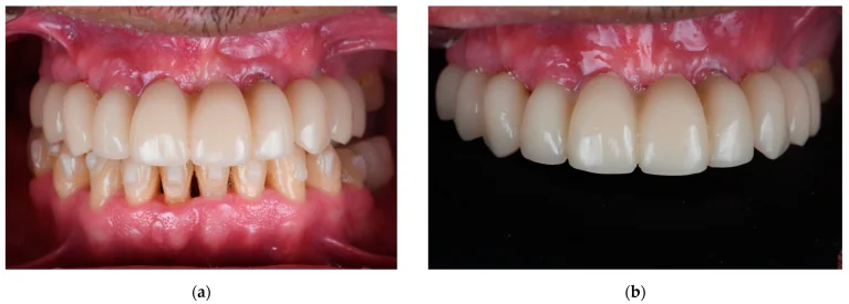 Two intraoral views of the published maxillary PMMA fixed interim prosthesis at three months.