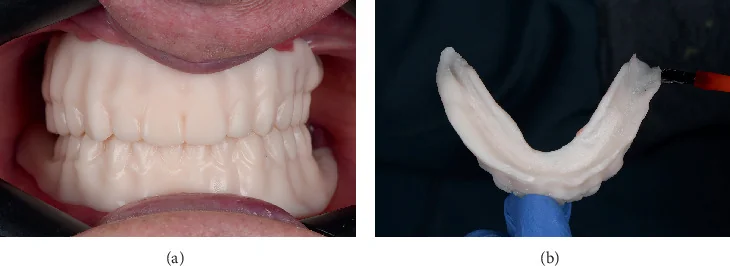 Printed upper and lower trial dentures in the mouth beside adhesive being applied to a mandibular trial denture.