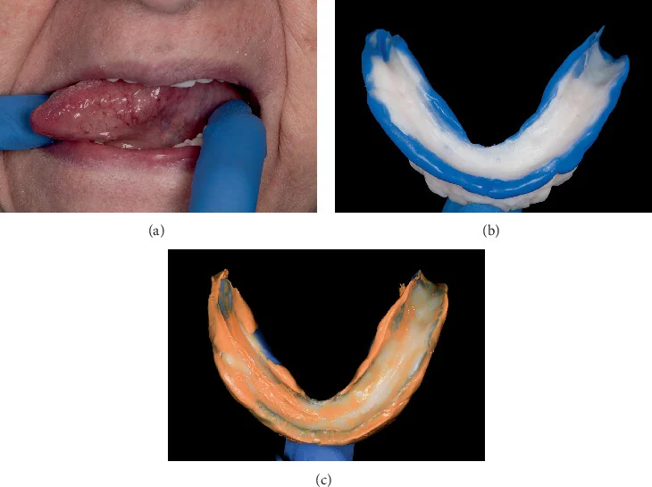 Three clinical panels showing tongue movement, blue mandibular border molding, and a final wash impression.