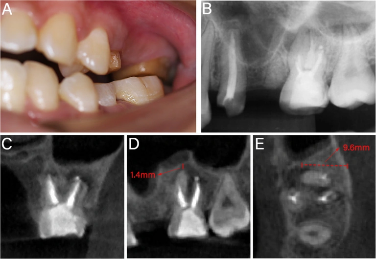Source Figure 1, panels A–E: upper posterior teeth, a periapical radiograph and CBCT sections with the original 1.4 mm and 9.6 mm annotations.