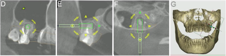 Source Figure 2, panels D–G: CBCT sections with the virtual trephine path and a three-dimensional jaw planning view.