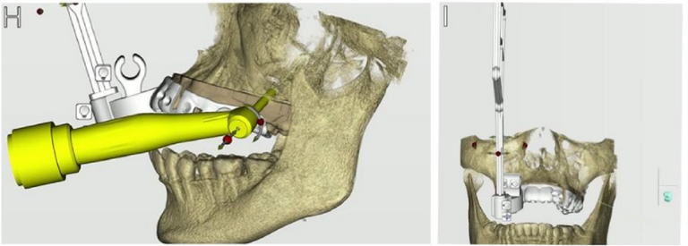 Source Figure 2, panels H–I: a virtual handpiece approaching the upper molar and the planned dental accessory with its vertical optical marker.
