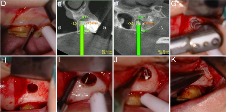 Source Figure 3, panels D–K: flap exposure, two navigation screens, manual root-end surgery, retrograde preparation and filling, and membrane placement.