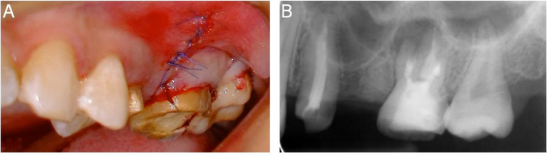 Source Figure 4, panels A–B: sutures closing the surgical flap and the immediate postoperative periapical radiograph.