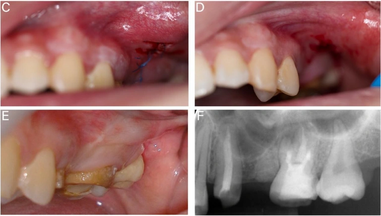 Source Figure 4, panels C–F: one-week wound and suture review above the six-month intraoral photograph and periapical radiograph.